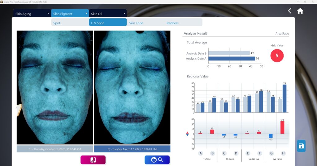 Shelly gallegos_Compare_UV Spots2