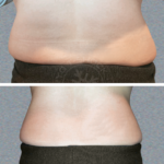 4+slimming