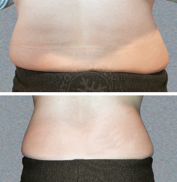 4+slimming
