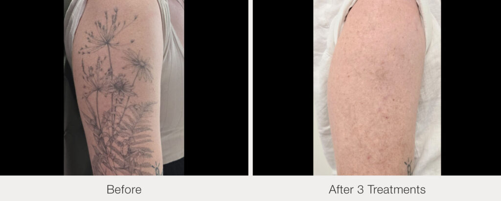 ARO Medspa Tattoo Removal_0000_63f83354eeb7456abbfe2bfbf0b353c9