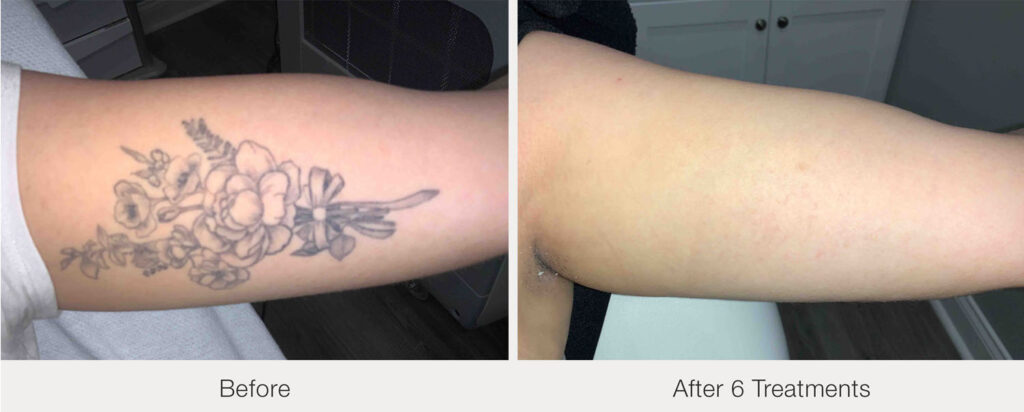 ARO Medspa Tattoo Removal_0001_40b31a958910453db793ea60aa9d9b95