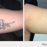 ARO Medspa Tattoo Removal_0001_40b31a958910453db793ea60aa9d9b95