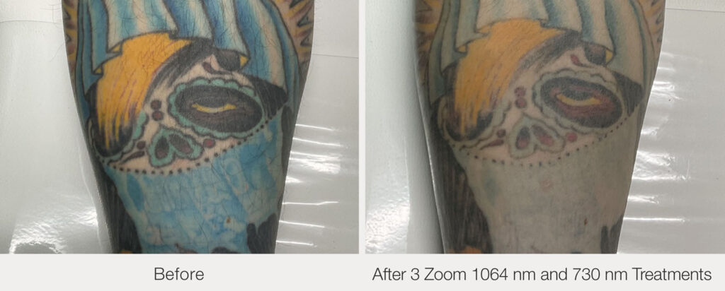 ARO Medspa Tattoo Removal_0002_2038f66133654cdeb6e59cc42a332a08
