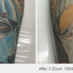 ARO Medspa Tattoo Removal_0002_2038f66133654cdeb6e59cc42a332a08