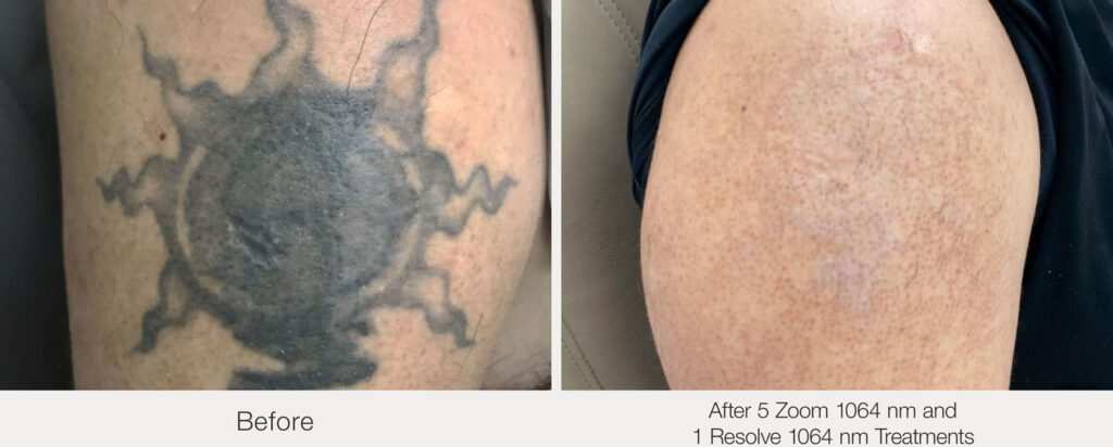 ARO Medspa Tattoo Removal_0003_699efa0ef71a481a9229d40dcf1799d1