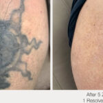ARO Medspa Tattoo Removal_0003_699efa0ef71a481a9229d40dcf1799d1