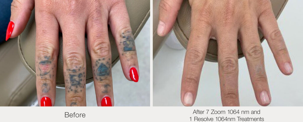 ARO Medspa Tattoo Removal_0005_3db48a0cbfda4948885f9a8c0c0b8006