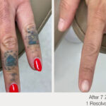 ARO Medspa Tattoo Removal_0005_3db48a0cbfda4948885f9a8c0c0b8006