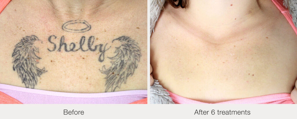 ARO Medspa Tattoo Removal_0008_cf19938f909f49cbad48cdd9911a6f47
