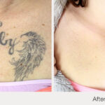 ARO Medspa Tattoo Removal_0008_cf19938f909f49cbad48cdd9911a6f47