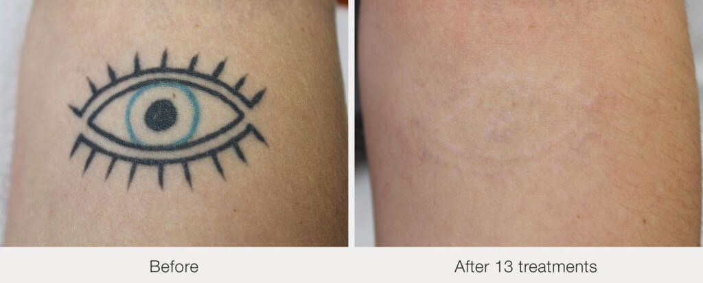 ARO Medspa Tattoo Removal_0009_85fcafcad9f3451fb6644d2b89f1ff0b