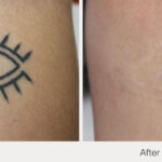 ARO Medspa Tattoo Removal_0009_85fcafcad9f3451fb6644d2b89f1ff0b