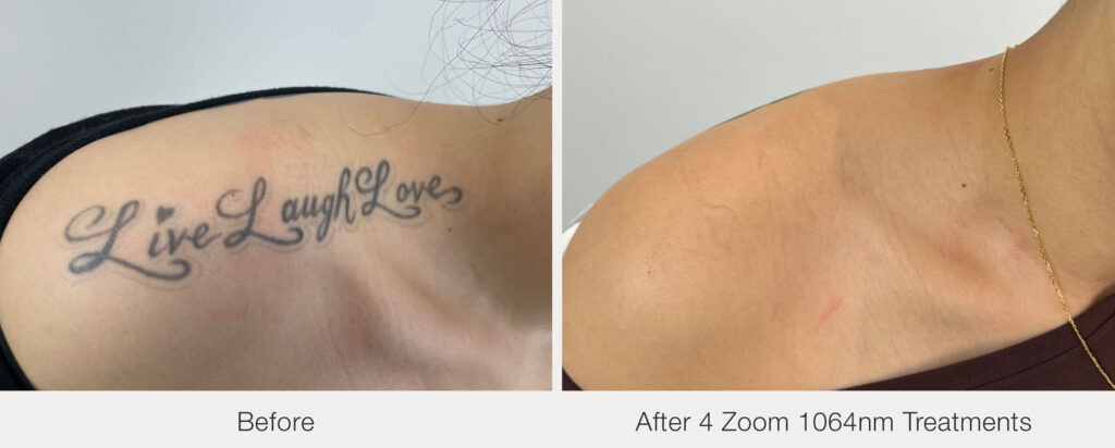 ARO Medspa Tattoo Removal_0010_BA-PicoWay-KDeCola-4Tx-029